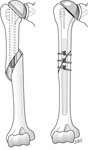 Reverse Total Shoulder