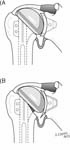 Reverse Total Shoulder