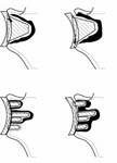 Reverse Total Shoulder