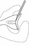Reverse Total Shoulder