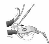 Reverse Total Shoulder