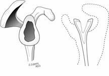 Reverse Total Shoulder