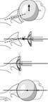 Reverse Total Shoulder
