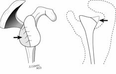 Reverse Total Shoulder