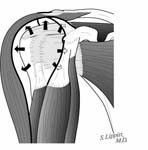 Reverse Total Shoulder Reverse Total Shoulder