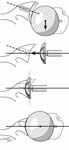 Reverse Total Shoulder