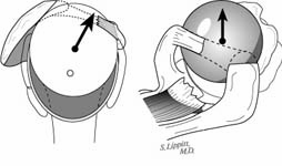Reverse Total Shoulder