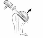Reverse Total Shoulder