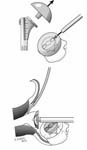Reverse Total Shoulder