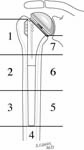 Reverse Total Shoulder