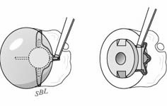 Reverse Total Shoulder