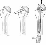 Reverse Total Shoulder