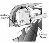 Reverse Total Shoulder Reverse Total Shoulder