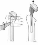 Reverse Total Shoulder