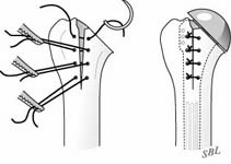 Reverse Total Shoulder