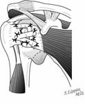 Reverse Total Shoulder Reverse Total Shoulder