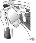 Reverse Total Shoulder Reverse Total Shoulder