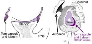 Bankart Lesion Fig 11 - Traumatic anterior instability
