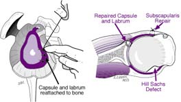 Bankart Lesion Fig 14 - Anatomical repair for ligaments and labrum