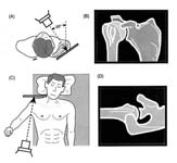 Bankart Lesion Fig 2 - Shoulder dislocation. AP and Axillary x-ray views