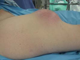 Soft Tissue Masses. Sarcoma in the thigh.