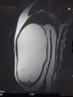 Soft Tissue Masses. Soft Tissue Mass on an MRI