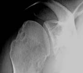 Bankart Lesion Fig 4 - Shoulder dislocation - apical oblique view showing a Hill Sachs defect of the humeral head and a defect of the anterior inferior rim of the glenoid