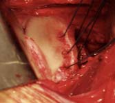 Bankart Lesion Fig 5 - Shoulder dislocation -Bankart lesion with repair sutures placed through the bone edge