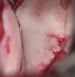 Bankart Lesion Fig 7 - Shoulder dislocation - fracture of the anterior inferior glenoid lip