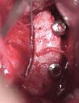 Bankart Lesion Fig 8 - Shoulder dislocation - bone graft held in place with screws to replace the anterior - inferior glenoid bony defect