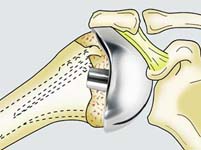 Reverse Total Shoulder Reverse Total Shoulder