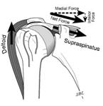 Reverse Total Shoulder