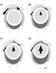 Reverse Total Shoulder