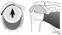 Reverse Total Shoulder