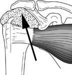 Reverse Total Shoulder