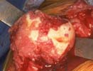 Rotator cuff tear arthropathy with collapse of the humeral head