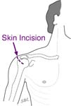 Fig. 13. Location of insicion for rotator cuff surgery.