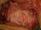 Small tear involving the supraspinatus tendon only