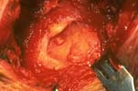 Large tear involving the supraspinatus and infraspinatus