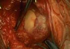 Large rotator cuff tear with poor quality tissue