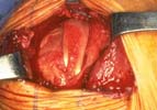 Large rotator cuff tear with early loss of the cartilage of the humeral head (rotator cuff tear arthropathy)