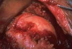Large rotator cuff tear that is not reparable