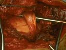 Massive rotator cuff tear with rotator cuff tear arthropathy