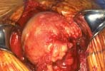 Complete failure of rotator cuff with rotator cuff tear arthropathy