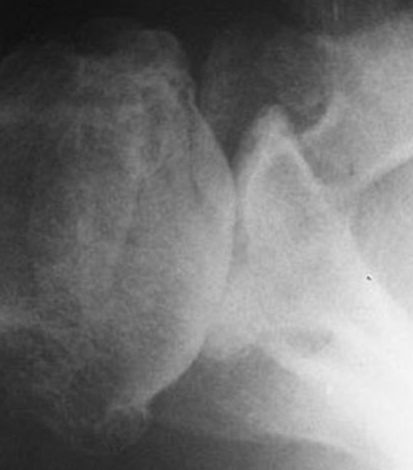 Figure 7: Axillary view of an arthritic shoulder